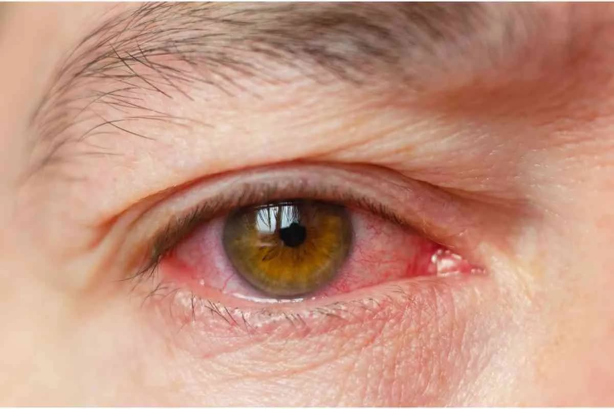 olho-vermelho-apos-cirurgia-catarata