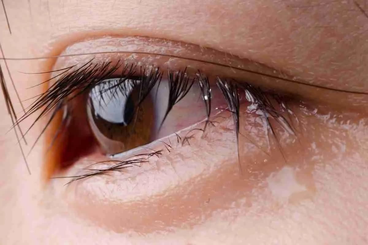 olhos-lacrimejando-apos-cirurgia-de-catarata