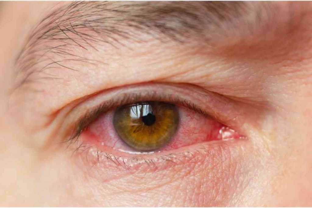 olho-vermelho-apos-cirurgia-catarata